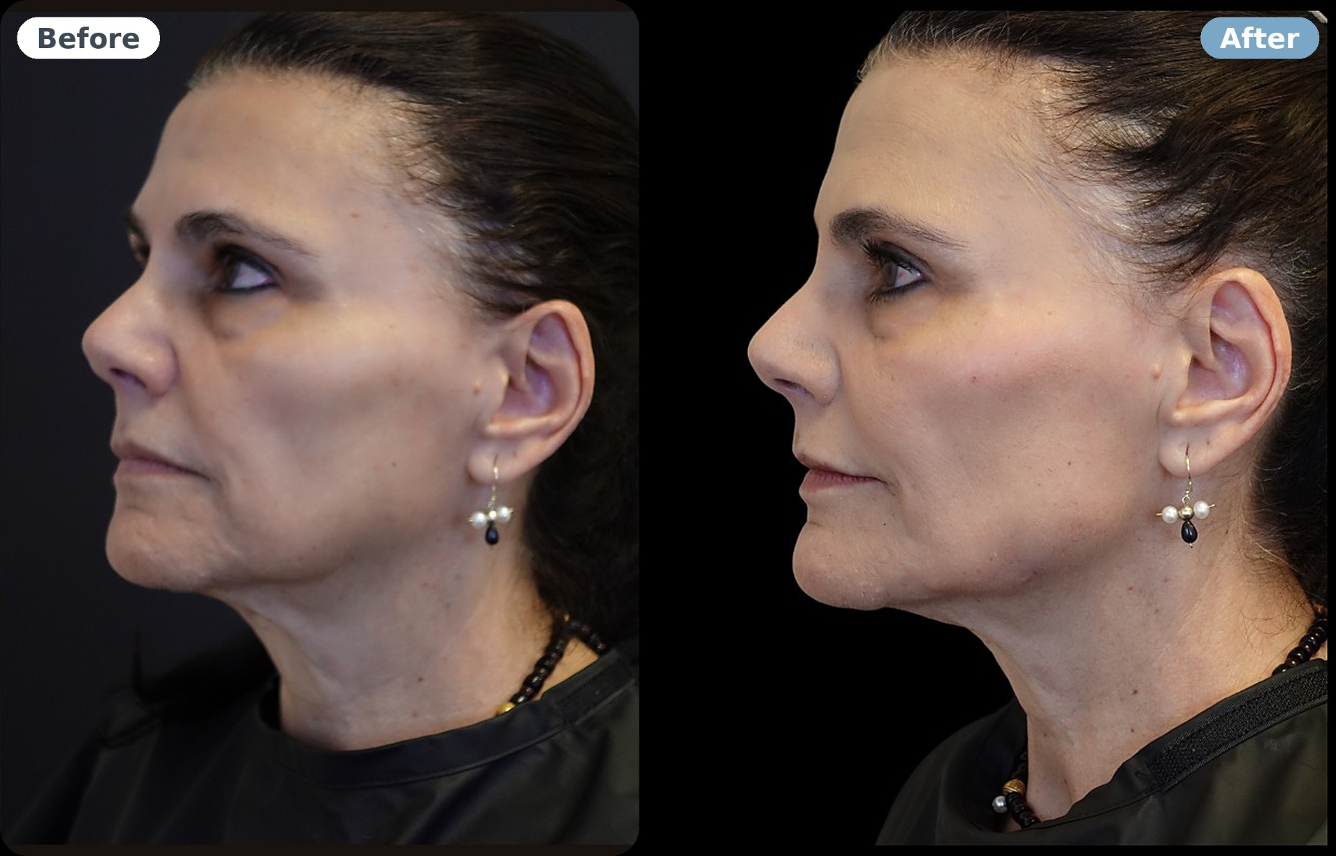 Facial optimization