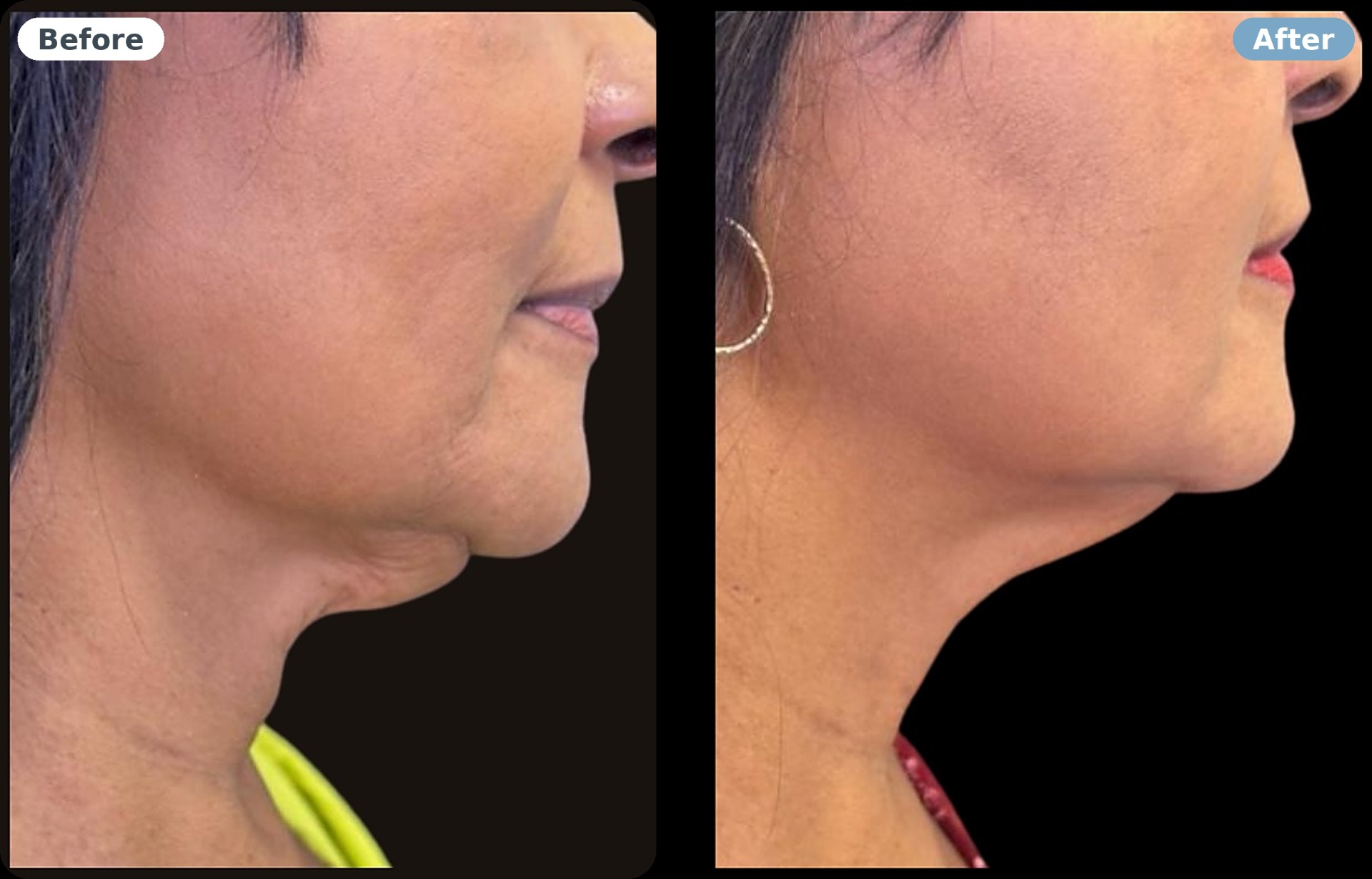 Neck profile