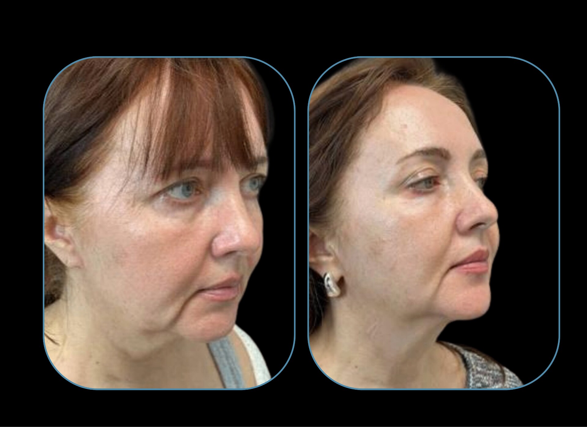 3/4 facial lift