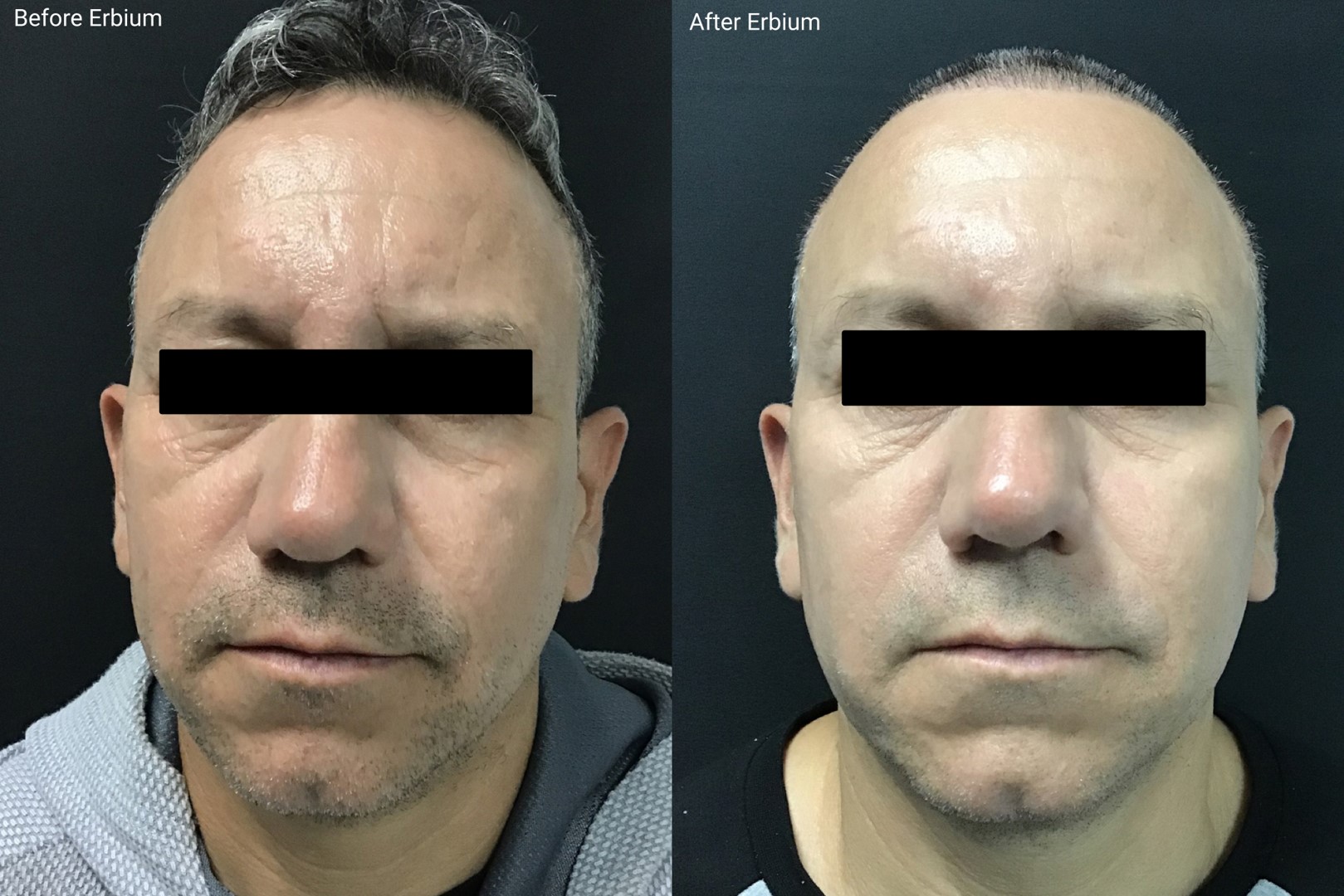 Texture & pores — male