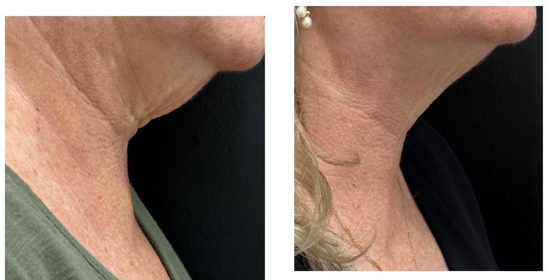 Neck firmness