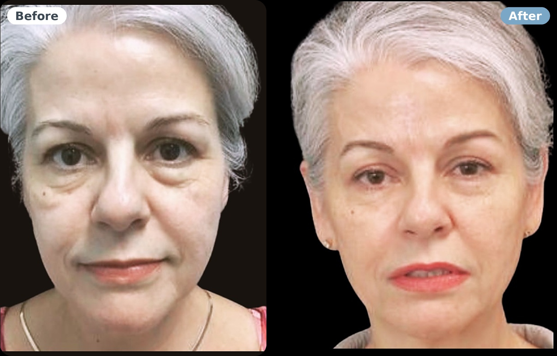 Eye bags & biostimulation