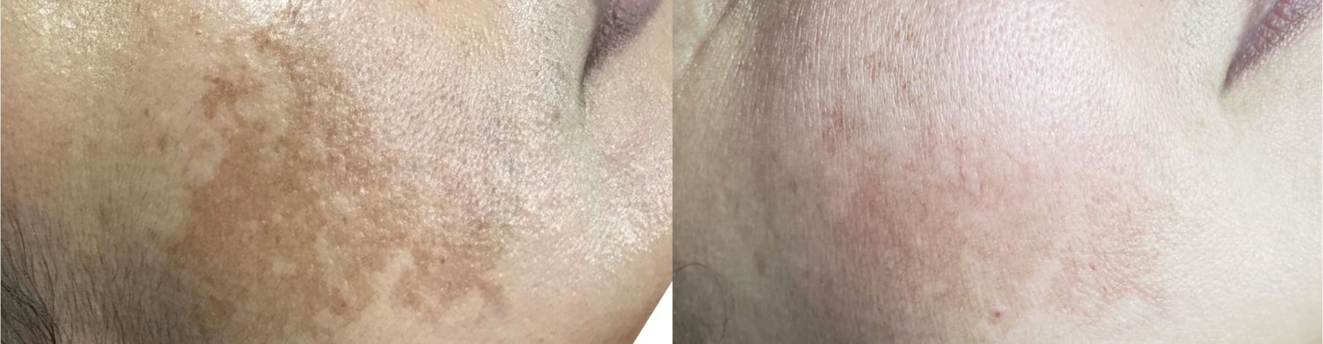 Sun spots & melasma