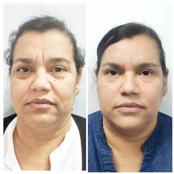 Full facial rejuvenation