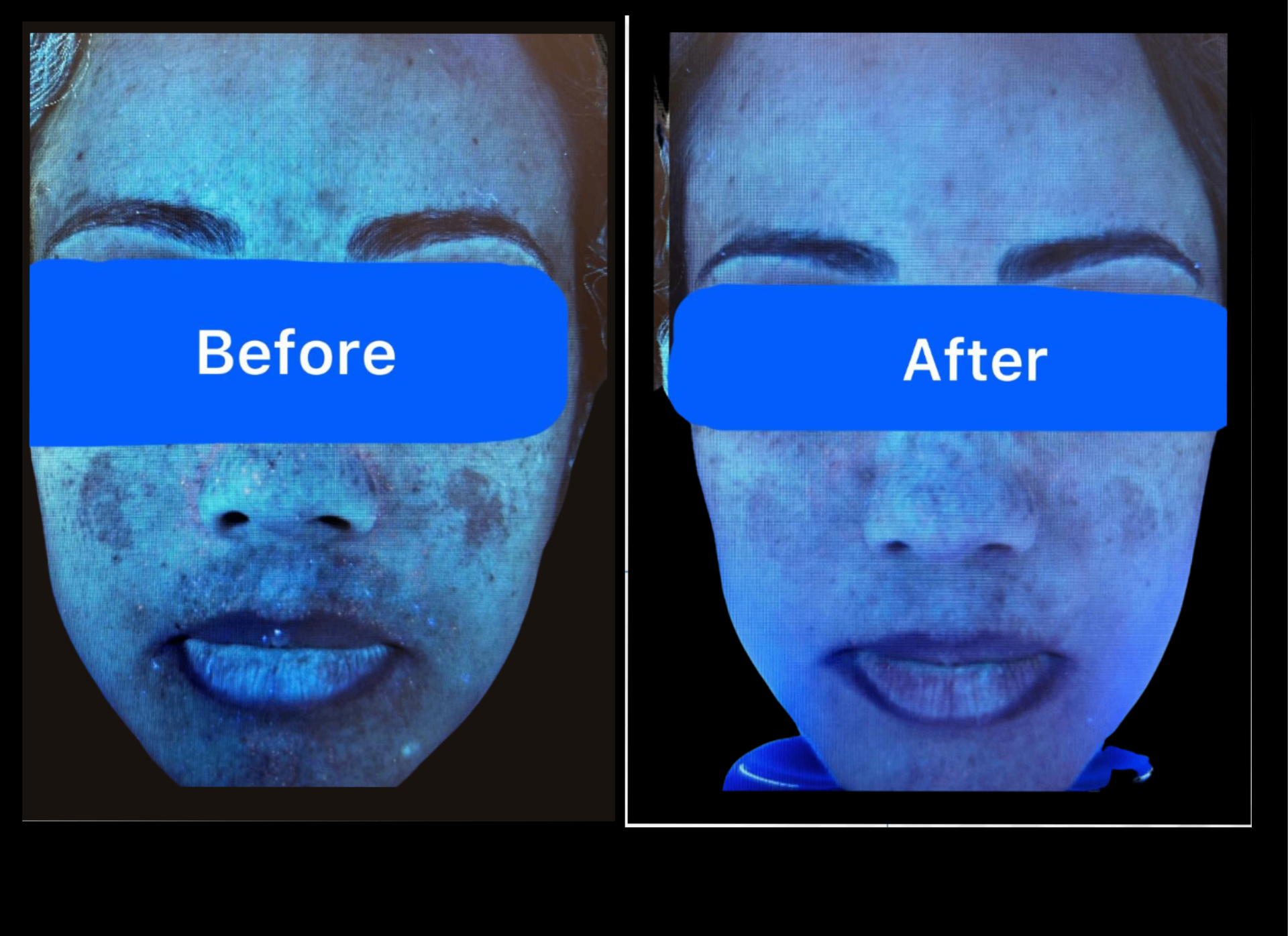 UV analysis — deep pigmentation